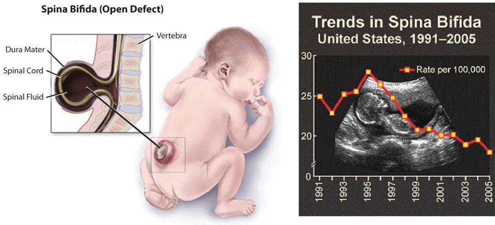 Spina Bifida in an infant