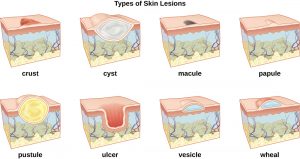 Types of Skin Lesions- crust-cyst-macule-papule-pustule-ulcer-vesicle-wheal