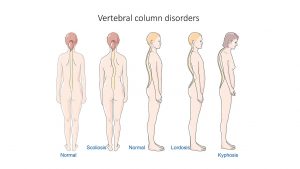 Skeleton and bones - Normal, Scoliosis, Lordosis, and Kyphosis