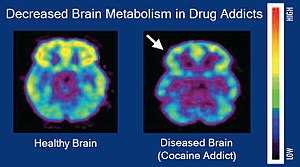 Decreased Brain Metabolism in Drug Addicts