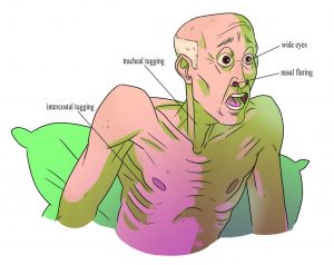 Signs of Respiratory Distress